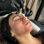 Houston microneedling