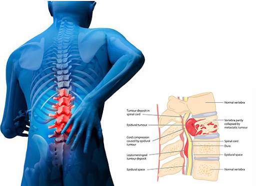 Medical illustration showing spinal cord pain and vertebrae damage in the lower back