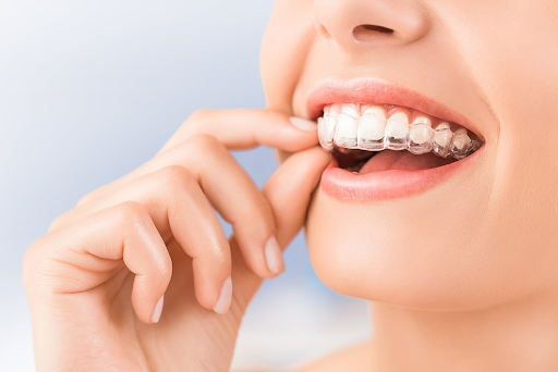 How to Find an Aligner Option That Fits Your Daily Routine
